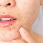 Acne in adult Causes, Treatment & Prevention