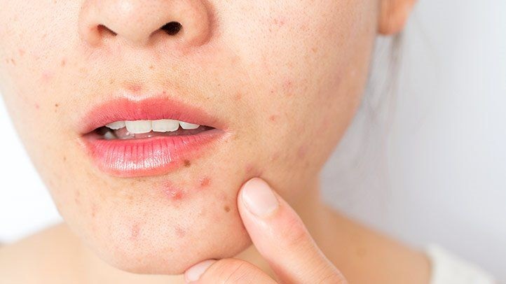 Acne in adult Causes, Treatment & Prevention