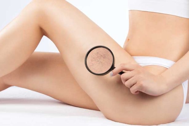 Can Spider Veins Go Away?