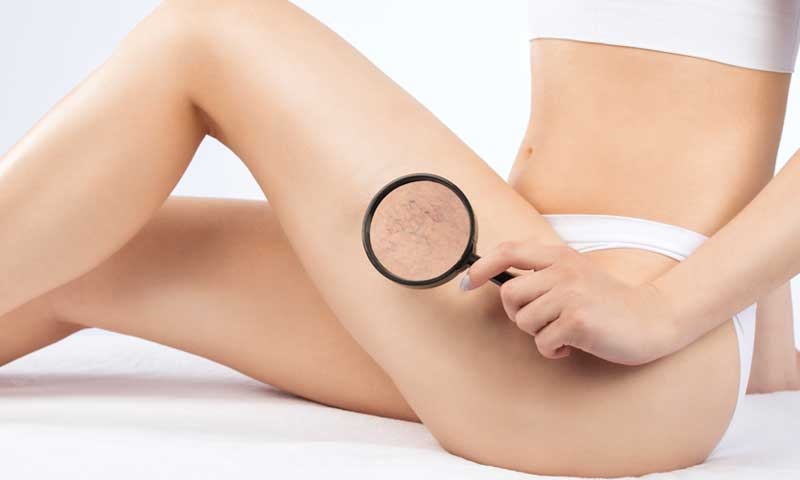 Can Spider Veins Go Away?